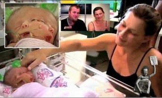 Πέθανε το μωρό με τα δύο πρόσωπα – Άντεξε μόνο 19 μέρες