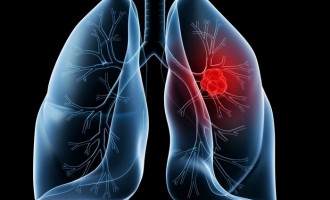 Συσκευή “μυρίζει” το καρκίνο του πνεύμονα