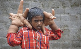 Ινδία: Σοκάρει ο 8χρονος με τα χέρια που ζυγίζουν 12,5 κιλά (εικόνες)