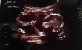 Δείτε το έμβρυο που έγινε viral από το… υπερηχογράφημα (φωτογραφία)