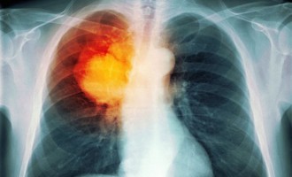 Πειραματικό φάρμακο εξαφανίζει όγκους ανθρωπίνων πνευμόνων σε πειραματόζωα