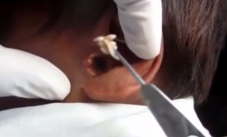 Ανατριχιαστικό: Είχε γεμίσει το αυτί του σκουλίκια (βίντεο)