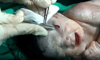 Κοριτσάκι γεννήθηκε με θραύσμα από οβίδα στο κεφάλι (φωτο + βίντεο)