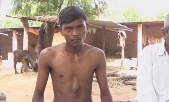 Σπάνιο ιατρικό φαινόμενο – Ινδός ζει με εξωτερική καρδιά (βίντεο)