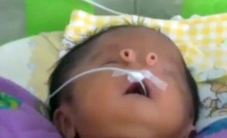 Βρέφος γεννήθηκε με σωληνάκια αντί για μύτη (φωτο + βίντεο)