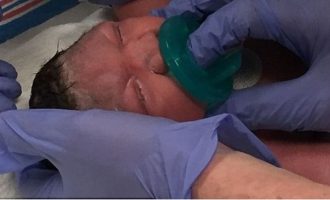 Μωρό με μικροκεφαλία λόγω Ζίκα γεννήθηκε στις ΗΠΑ