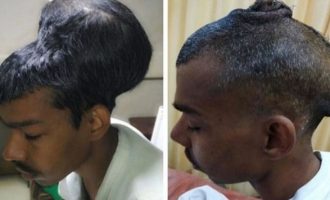 31χρονος Ινδός είχε όγκο δύο κιλών στο κεφάλι του