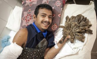 Ξανά στο χειρουργείο ο 28χρονος από το Μπαγκλαντές με τη σπάνια γενετική διαταραχή