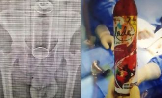 40χρονος «μερακλής» ζήτησε από τη γυναίκα του να του «χώσει» ένα αποσμητικό και κατέληξε στο χειρουργείο (φωτο)