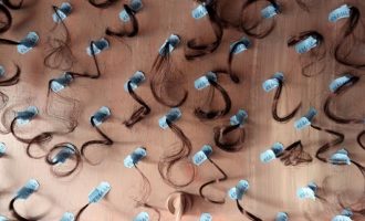 Η μεταμόσχευση μαλλιών φέρνει κέρδη στην Τουρκία – Στο 1 δισ. ο τζίρος
