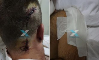 Μετανάστης μαχαίρωσε στον λαιμό αστυνομικό στη Ροδόπη (φωτο)