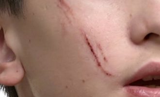 14χρονος «χαράκωσε» με κλειδί στο πρόσωπο συμμαθητή του στην Καλλιθέα (βίντεο)