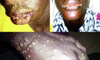 Μυστηριώδης δερματική ασθένεια πρόσβαλε πάνω από 1.000 ψαράδες στη Σενεγάλη (φωτο)