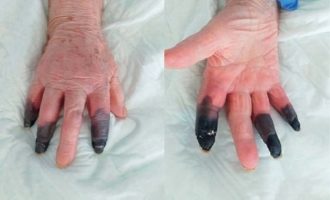 Μαύρισαν τα δάχτυλα ασθενούς με Covid-19 και τα ακρωτηρίασε
